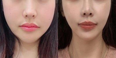 18-24 year old woman treated with Lipodissolve - Fat-dissolving injections to contour the facial line