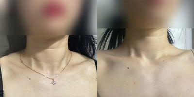35-44 year old woman treated with Lipodissolve - Fat-dissolving injections to contour the shoulder line