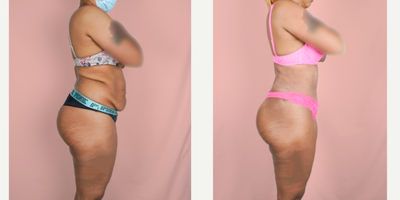 25-34 year old woman treated with Vaser Liposuction - This patient underwent a tummy tuck and flank liposuction procedure. She is shown 1-month post-op.