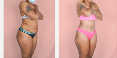 25-34 year old woman treated with Vaser Liposuction - This wonderful patient underwent a tummy tuck and flank liposuction procedure. She is shown 1-month post-op.