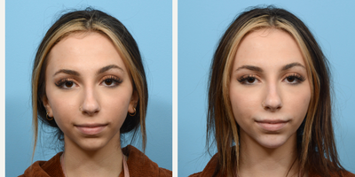 18-24 year old woman treated with Dermal Fillers - This 21-year-old patient turned to Dr. Wise for a more defined jawline and increased projection for her chin. Not quite ready to commit to chin implant surgery, she opted for dermal fillers and is thrilled with the beautiful outcome.