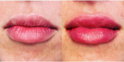 Woman treated with Dermal Fillers - Woman treated with Dermal Fillers
