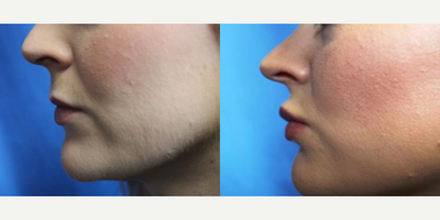 24 year old woman treated with Lip Fillers - 24 year old woman treated with Dermal Fillers, Lip Fillers
