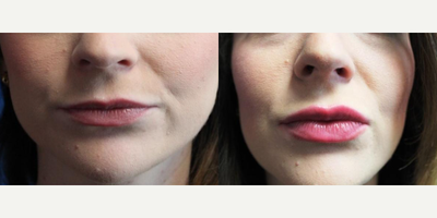 24 year old woman treated with Lip Fillers - 24 year old woman treated with Dermal Fillers, Lip Fillers