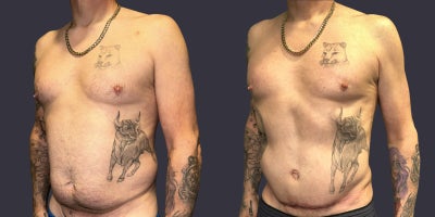 45-54 year old man treated with Male Tummy Tuck, Liposuction, Tummy Tuck - This 48 year old man is 5'6 tall and weighs 166 pounds. He had an abdominoplasty, (tummy tuck), and liposuction performed.