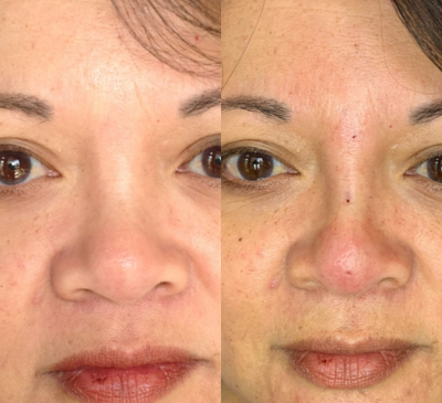45-54 year old woman treated with threads for Nonsurgical Nose Job - Patient had bump in nose that bothered her. The doctor used threads to smooth bump and narrow appearance of nose. Before and after photos are same day as procedure as results are immediate.