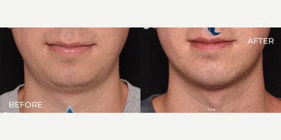 Man treated with Chin Filler - Man treated with Chin Filler