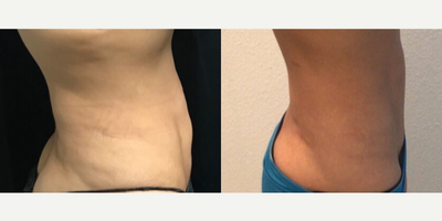 35-44 year old woman treated with CoolTone - Procedure: CoolToneGender: FemaleEthnicity: CaucasianAge: 36 - 40