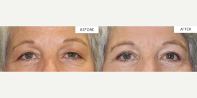 Woman treated with Eyelid Surgery - Patient had a right upper lid blepharoplasty with a Left External Levator Advancement.
