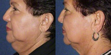 Kybella Before and After Photos