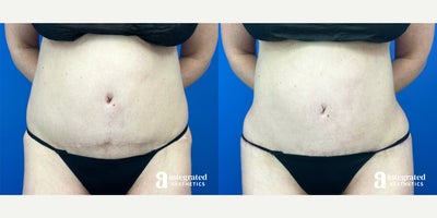 35-44 year old woman treated with Scar Removal and Fat Grafting - The patient is a 44-year-old female who had concerns with the appearance of her abdomen and lateral buttocks. The patient previously underwent an abdominoplasty with Lipo 360 and inner thigh liposuction. Dr. Cho performed an abdominoplasty scar revision and fat grafting to the lateral buttocks and hip dips. The after results are 3 months post-procedure.