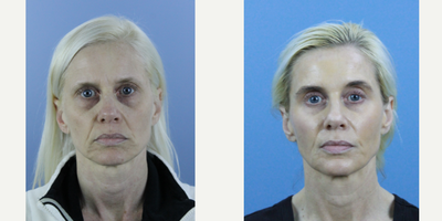 45-54 year old woman treated with Bellafill, Thread Lift - Bellafill Volume replacement and Non-Surgical Threads