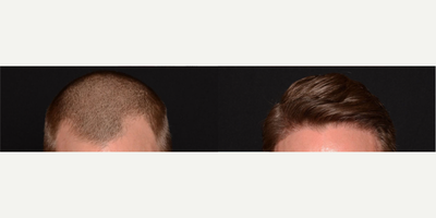 Man treated with Hair Transplant - Man treated with Hair Transplant.