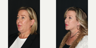 Woman treated with Facelift - This patient wanted to achieve a youthful natural look. I performed a facelift, neck lift, and upper blepharoplasty under local anesthesia to help her restore more refreshed appearance. Her jawline and neck are more defined and her eyes look more rested. She is 3 months postop. (Facelift , Neck Lift , Upper Blepharoplast)