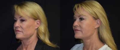 55-64 year old woman treated with Facelift - Lower Face and Necklift; Upper Blepharoplasty; Fat Grafting to Cheeks; Perioral Dermabrasion