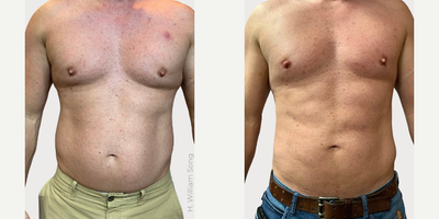 Man treated with Vaser Liposuction - Man treated with Vaser Liposuction