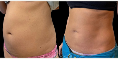 Woman treated with Vaser Liposuction - Woman treated with Vaser Liposuction