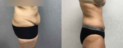 Patient treated with Tummy Tuck - Patient treated with Tummy Tuck