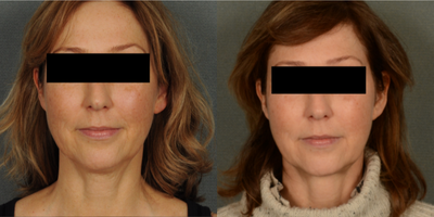 55-64 year old woman treated with Facelift - Neck lift