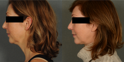 55-64 year old woman treated with Facelift - Neck lift