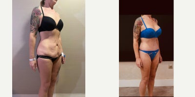35-44 year old woman treated with Mommy Makeover - 360 lipectomyFDLAbdominal repairMons liftBreast Augmentation