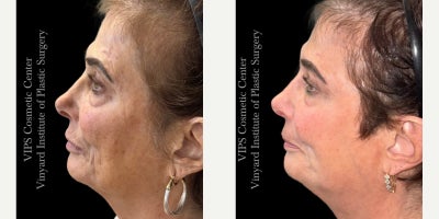 55-64 year old woman treated with CoolPeel, Skin Lightening, CO2 Laser, Skin Rejuvenation, IPL - This patient underwent a single-session combination treatment using CoolPeel laser resurfacing and the Elluminate Advanced Photofacial with IPL to address sun damage, hyperpigmentation, enlarged pores, and overall skin dullness.Her photos show brighter, more even-toned skin with softening of discoloration across the cheeks, temples, and lower face. Fine lines appear smoother, the complexion looks clearer and more refined, and the surface texture shows a noticeable boost in radiance and uniformity. By pairing fractional CO resurfacing with a multi-wavelength photofacial, this treatment targets both superficial and deeper pigment irregularities while stimulating collagen for long-term rejuvenation.This single combined session delivered a healthier, more refreshed complexion with improved clarity, reduced pigmentation, and a smoother overall appearancean excellent option for patients seeking visible skin renewal with little to no downtime.