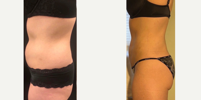 25-34 year old woman treated with Liposuction - 2 months s/p SAFE LIPO