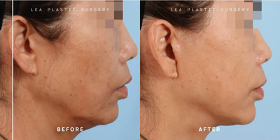 Woman treated with Facelift - Woman treated with Facelift