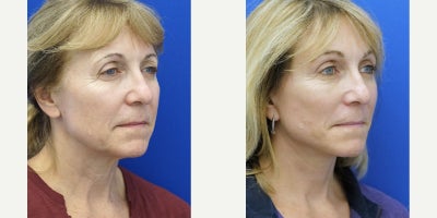 55-64 year old woman treated with Brow Lift, Deep Plane Facelift, Eyelid Surgery - Patients with long forehead and sagging eyebrows who wear bangs are excellent candidates for hairline browlift. She undergoes facial and neck surgical rejuvenation which includes the upper eyelids for a natural appearing result.