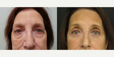 55-64 year old woman treated with Eyelid Surgery, Brow Lift - This patient underwent a Facelift, Endoscopic browlift, Upper/Lower Lid Blepharoplasty, Fat Transfer to glabella, forehead, lateral brow, n/l folds, oral commissures, cheeks, fine lines around the lips, lips and chin