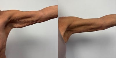 45-54 year old woman treated with Arm Lift - 6 months after an arm lift
