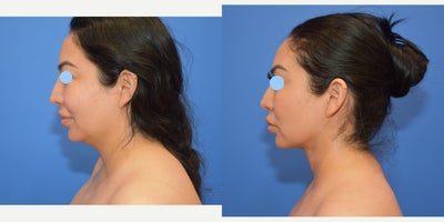 35-44 year old woman treated with Neck Lift, Chin Liposuction - Women treated with Neck lift and chin liposuction