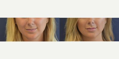 Lip augmentation with Juvederm - Non surgical lip augmentation with Juvederm