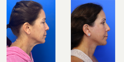 55-64 year old woman treated with Facelift, Neck Lift, Eyelid Surgery, Facial Fat Transfer, Laser Resurfacing - 57 year old patient 4 months after a Facelift, Neck lift, Upper and lower eyelid blepharoplasty, facial fat transfer and co2 laser.
