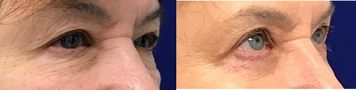 65-74 year old woman treated with Eyelid Surgery - 69 year old patient underwent an Upper Blepharoplasty. Here she is 3 months post op and 6 months post op, very happy with her rejuvenated eyes.