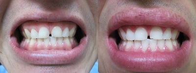 Zoom Teeth Whitening -
Stained and discolored teeth have been whitened using Zoom In Office Whitening.