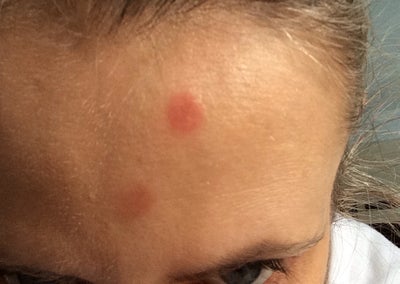 forehead red spots cancer could else they so