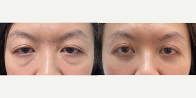45-54 year old woman treated with Double Eyelid Surgery, Eyelid Surgery, Ptosis Surgery - Upper lid ptosis repair and Asian blepharoplasty + lower eyelid blepharoplasty