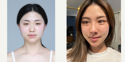 18-24 year old woman treated with Cheekbone Reduction - cheekbone reduction, jaw angle reduction, genioplasty, rhinoplasty, facial liposuction