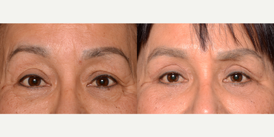 55-64 year old woman treated with Eyelid Surgery - Asian eyelid surgery to fix droopy eyelids.