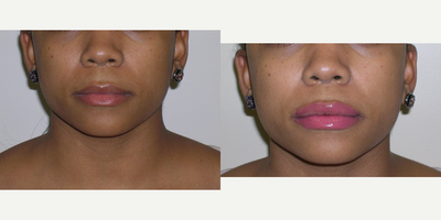 18-24 year old woman treated with Juvederm - 23 year old healthy female shown before and immediately after a lip augmentation using Juvederm one syringe.
