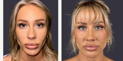 25-34 year old woman treated with Eyelid Surgery, CO2 Laser, ActiveFX - This 30 year old woman is 5'5 and 135 pounds. She presented requesting an eyelid lift. She had an upper eyelid blepharoplasty and and CO2 laser resurfacing of her lower eyelids and crows feet area.