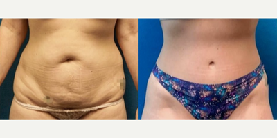 Woman treated with Tummy Tuck - Woman treated with Extended Tummy Tuck as well as Liposuction to reduce excess tissues around her midsection