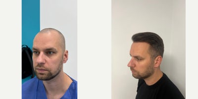 25-34 year old man treated with DHI Hair Transplant - This case presents the result at 9 months after a DHI hair transplant procedure performed at FullFace Clinic.At this stage, the majority of transplanted hair has completed its active growth phase, showing stable density, natural direction, and consistent coverage in the treated areas. The hairline appears soft and age-appropriate, with no visible signs of overcorrection or artificial density.The procedure was carried out using the DHI (Direct Hair Implantation) technique, allowing precise control over graft placement, angulation, and depth. This approach supports natural-looking results and minimizes trauma to the scalp.At 9 months post-op, hair texture and thickness continue to mature, with further subtle improvements expected up to the 12-month mark. The donor area has healed well, with no visible scarring and preserved density.The patient reports satisfaction with both the aesthetic outcome and the overall treatment process, including medical supervision, post-operative care, and follow-up support provided by the clinic.