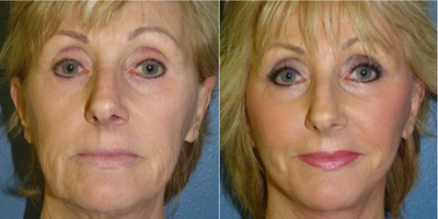 69 year old woman treated with SMAS Facelift - 69 year old woman treated with SMAS Facelift as well as Neck Lift, Facial Fat Transfer, and CO2 Laser Resurfacing to treat laxity, volume depletion, and improved texture, shown 3 years post op.