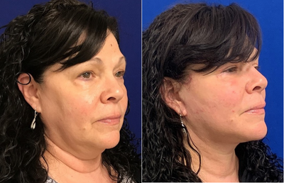 60 year old woman treated with Facelift - 60 year old woman treated with Facelift