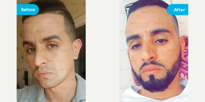 25-34 year old man treated with Beard Transplant - 25-34 year old man treated with Beard Transplant using Sapphire FUE