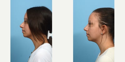 25-34 year old woman treated with Nonsurgical Nose Job - This patient opted for a non-surgical rhinoplasty with Dr. Wise to avoid the downtime associated with a surgical procedure. With strategic placement of dermal fillers, Dr. Wise was able to mask the bump on her nose. She loves the result.