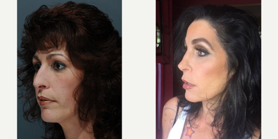 Woman treated with Rhinoplasty - This patient had a Rhinoplasty by Dr. Marotta.