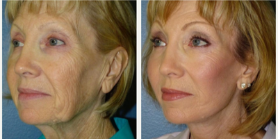 71 year old woman treated with Laser Resurfacing - 71 year old woman treated with CO2 Laser as well as SMAS Facelift, Neck Lift, and Facial Fat Transfer to treat laxity, volume depletion, and texture for overall facial rejuvenation. She is shown before and 6 months post op.